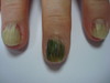 Синдром зеленых ногтей. №1863