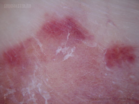 Пурпурозно-фестончатая форма дерматофитии стоп