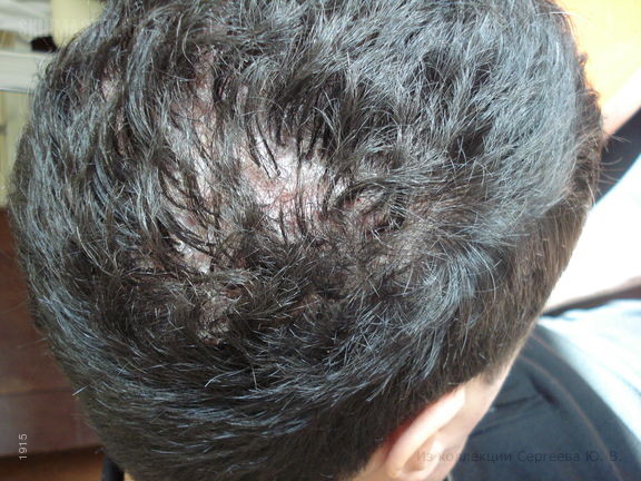 Фолликулярный шиповидный декальвирующий кератоз Сименса. Случай №554 из ...