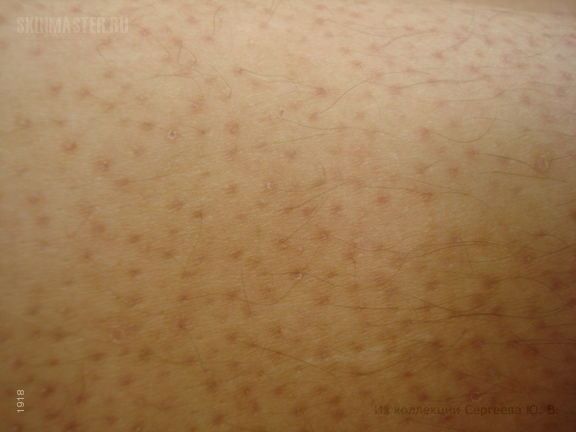 Фолликулярный шиповидный декальвирующий кератоз Сименса. Случай №554 из ...