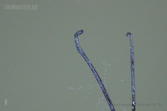 Фолликулярный шиповидный декальвирующий кератоз Сименса. Случай №554 из ...