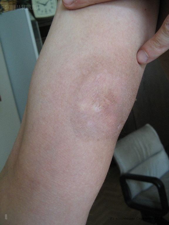 Т-клеточная лимфома кожи – грибовидный микоз