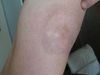 Т-клеточная лимфома кожи – грибовидный микоз. №200