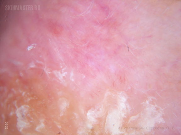 Актинический кератоз и плоскоклеточный рак кожи
