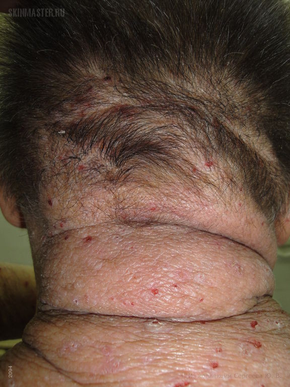 Диффузный нейродермит – атопический дерматит развившийся в позднем возрасте
