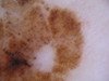 Лентиго-малигна (поверхностно-распространяющаяся меланома). №2208