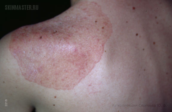 Хронический кандидоз кожи и слизистых как проявление АРС синдрома 1-го типа.
