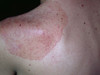 Хронический кандидоз кожи и слизистых как проявление АРС синдрома 1-го типа.. №2216