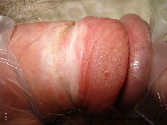 Парафимоз при склероатрофическом лишае и генитальная бородавка
