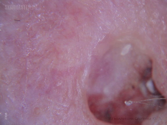 Плоскоклеточный рак кожи, язвенный тип