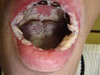 Кандидоз рта и глотки. Клинические фото #2317
