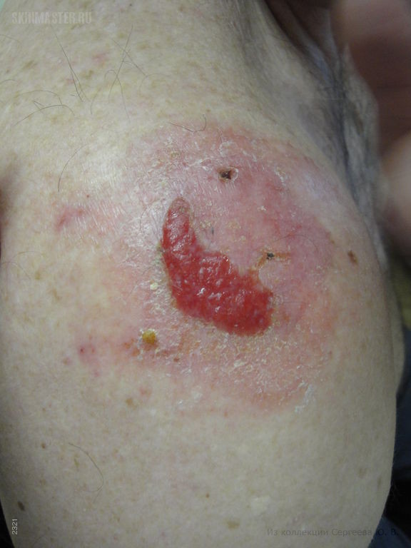 Диффузный воспалительный рак кожи