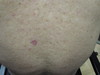 Диффузный воспалительный рак кожи. №2323
