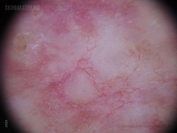 Диффузный воспалительный рак кожи