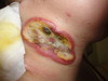 Т-клеточная лимфома кожи: «обезглавленный грибовидный микоз».. №2366
