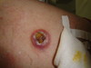 Т-клеточная лимфома кожи: «обезглавленный грибовидный микоз».. №2367