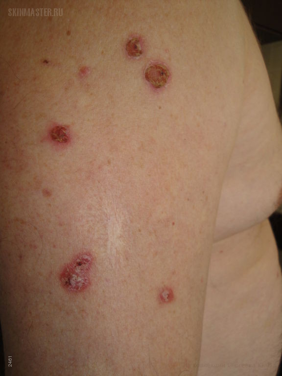 Пузырчатка фото