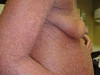 Сидром Сезари: Т-клеточная лимфома кожи. №2469