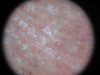Сидром Сезари: Т-клеточная лимфома кожи. №2471