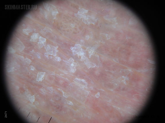 Сидром Сезари: Т-клеточная лимфома кожи