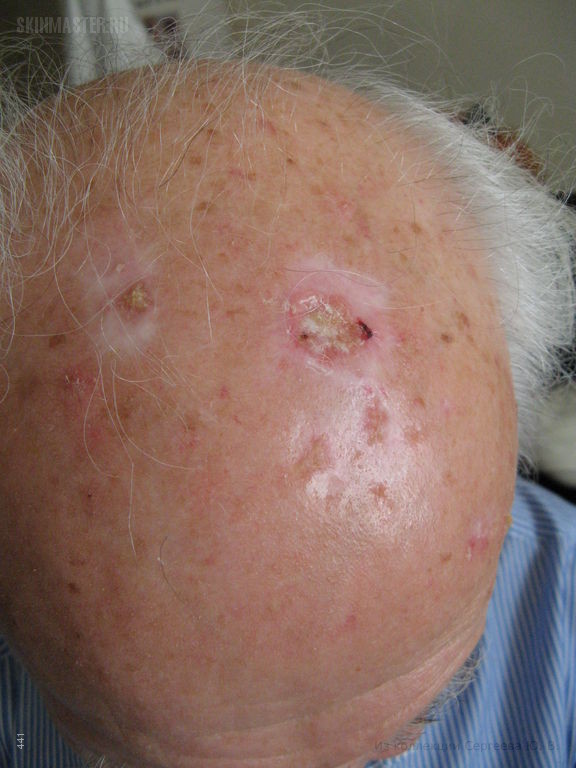 Базалиома фото