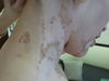   (halo nevus):  27