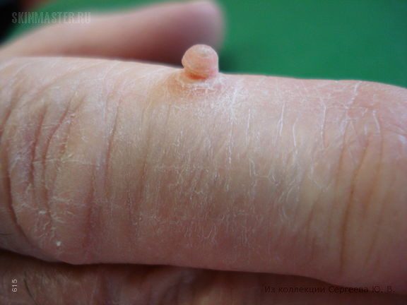 Приобретенная фиброкератома на пальце