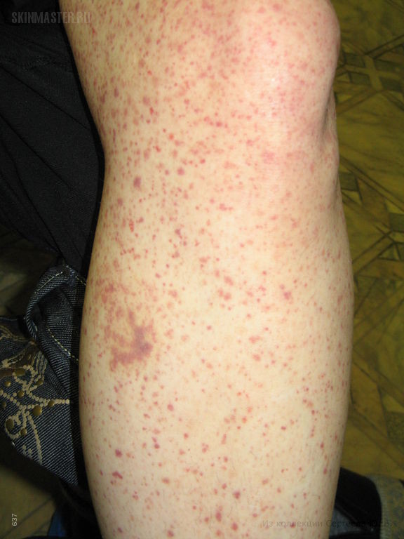 Аллергический васкулит кожи
