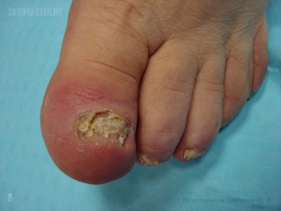 Паронихия и дерматофития ногтей