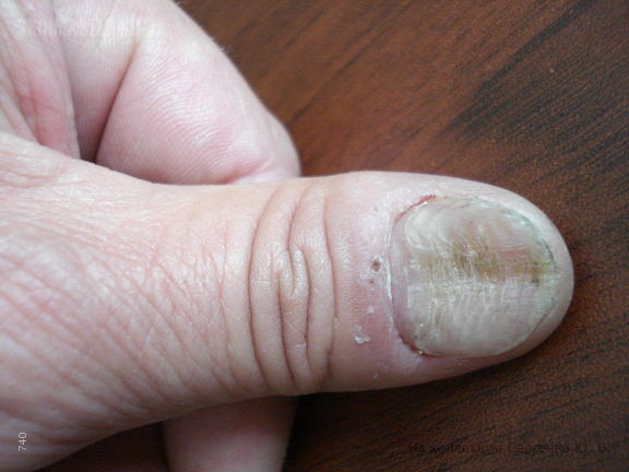 Срединная каналообразная дистрофия ногтей