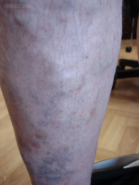 Синдром Клиппеля-Тренонея и болезнь Шамберга. Случай №342 из ...