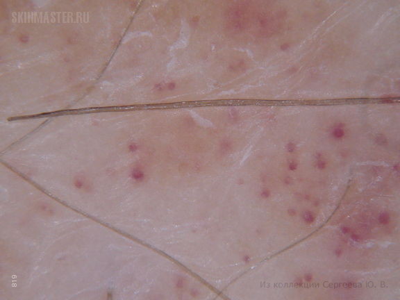 Синдром Клиппеля-Тренонея и болезнь Шамберга. Случай №342 из ...