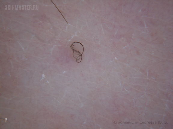 Гигантский врожденный меланоцитарный невус и закрученные вросшие волосы.