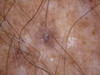 Гигантский врожденный меланоцитарный невус и закрученные вросшие волосы.. №828