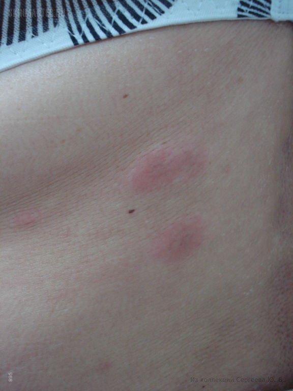    (erythema elevatum diutinum)