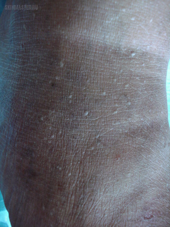   (stucco keratosis)  