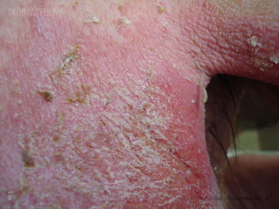 Аллергический контактный дерматит