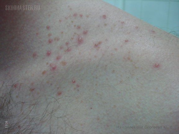   (acne aestivalis)