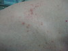   (acne aestivalis). 1110