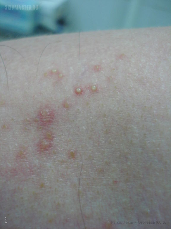   (acne aestivalis)