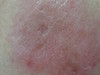 Лимфоплазия кожи. Клинические фото #1244