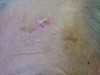 Плоскоклеточный рак кожи с ороговением. №1269