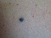 Невус голубой. Клинические фото #1295