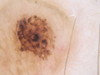 Дерматозы беременных: черная линия (linea nigra) и меланоцитарные невусы. №1311