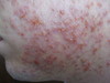 Экзематизированный фолликулит области бороды (folliculitis eczematoza barbae). №1376
