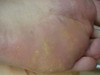 Кератодермия точечная. Клинические фото #1439