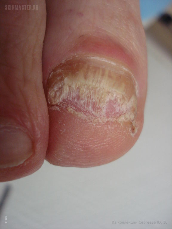 Онихомикоз и киста в области матрикса ногтя