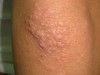 Аквагенная болезнь: шистосомный дерматит. №1508