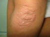 Аквагенная болезнь: шистосомный дерматит. №1509