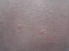 Аквагенная болезнь: шистосомный дерматит. №1511